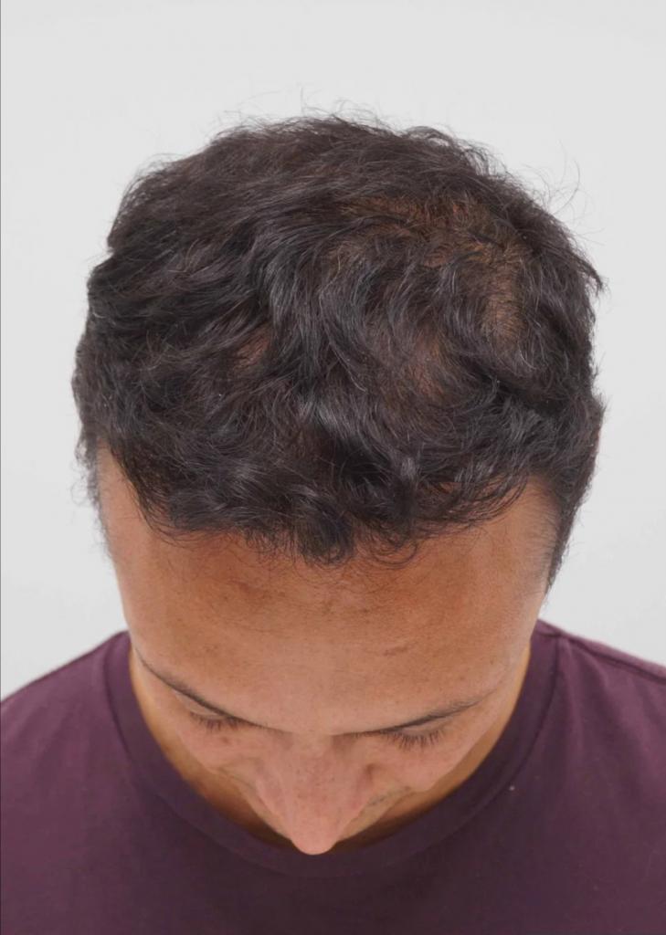 Мужчины до и после пересадки волос