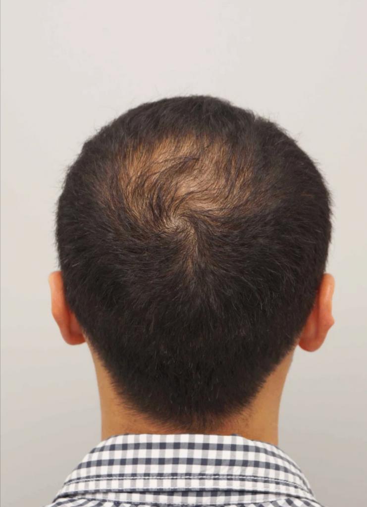 Мужчины до и после пересадки волос