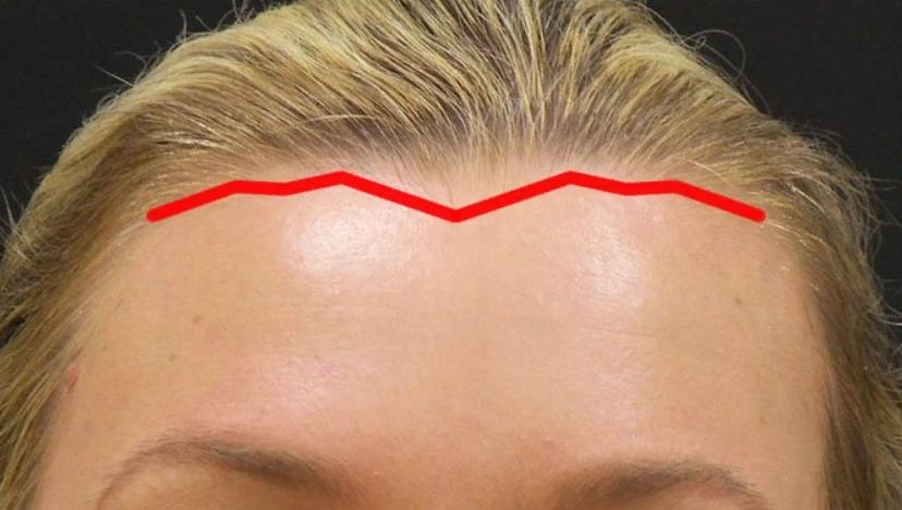 Линия роста волос в форме треугольника