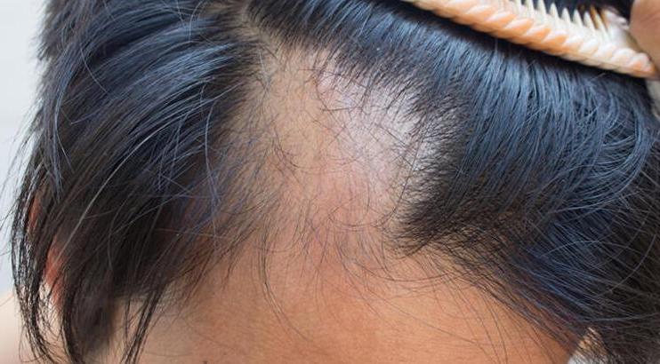 Что нового в лечении выпадения волос