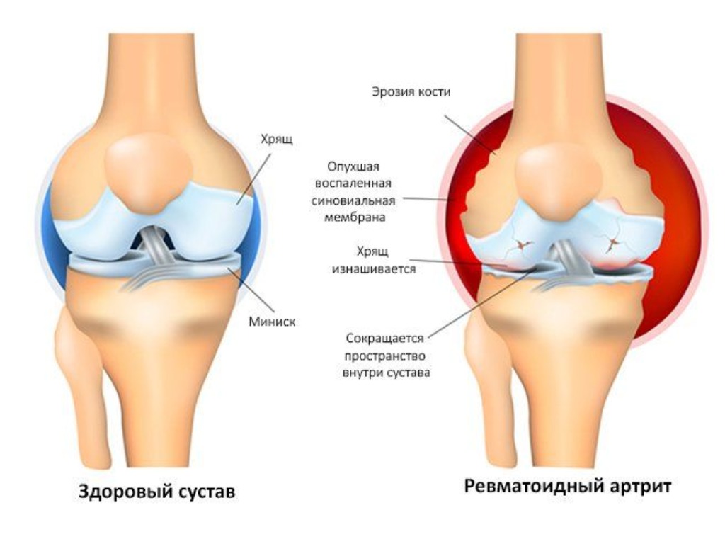 Венерическая болезнь при которой болят колени