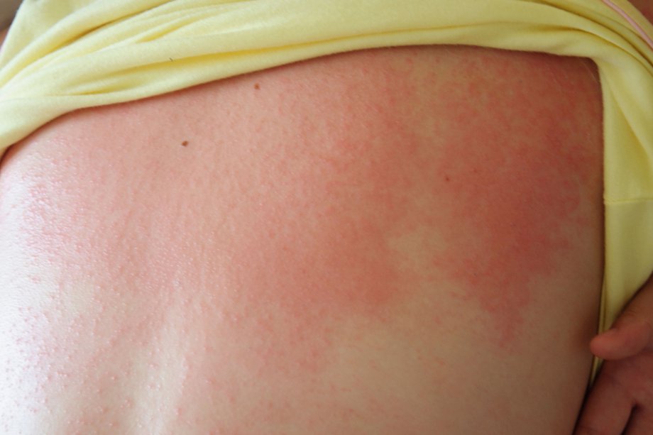 аллергия на груди шее