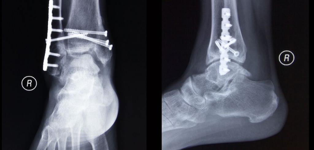 Лечение закрытого перелома внутренней лодыжки thumbnail