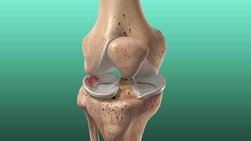 Разрыв переднего рога латерального мениска коленного сустава лечение thumbnail