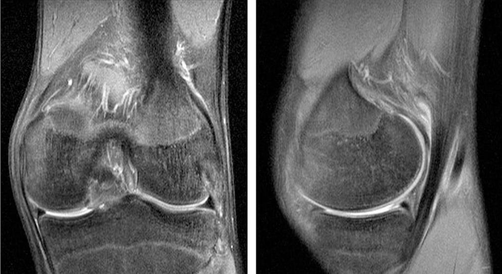 Разрыв латерального мениска коленного сустава нужна ли операция thumbnail