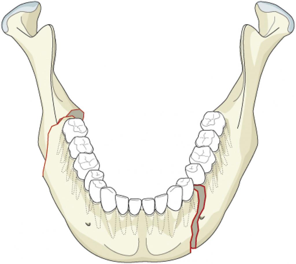 перелом нижней челюсти