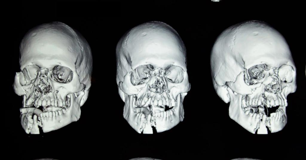 Переломы костей лицевого скелета thumbnail