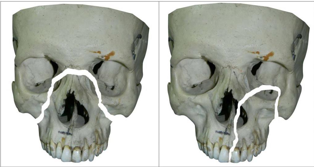 Лечение переломов костей лицевого скелета thumbnail