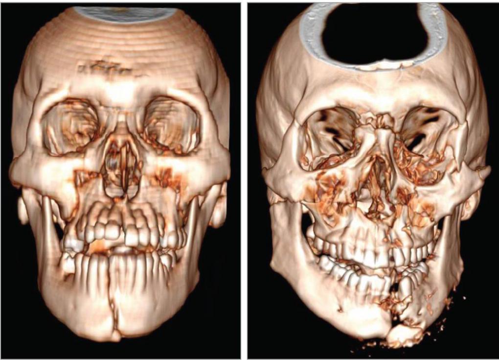 переломы костей лицевого скелета