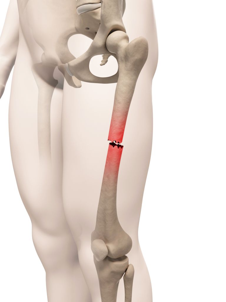 Остеосинтез при переломе бедренной кости thumbnail
