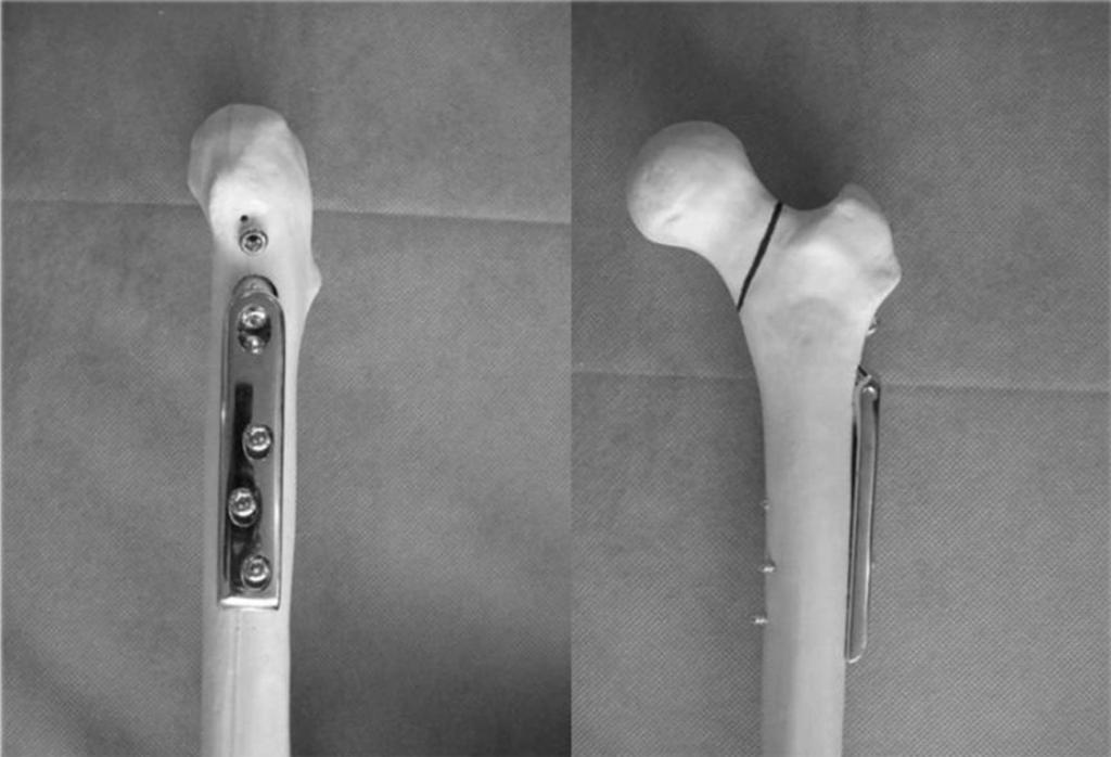 Интрамедуллярный остеосинтез переломов бедренной кости thumbnail