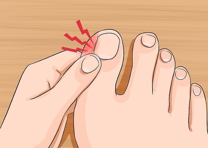 Болит палец на ноге около ногтя лечение thumbnail