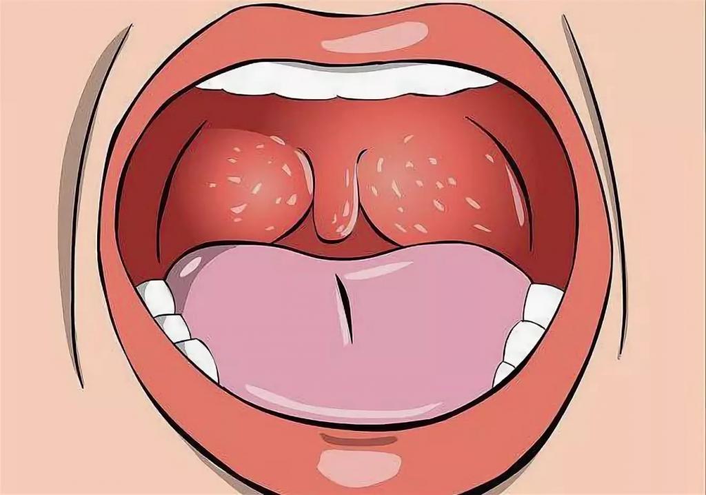 Стоматит в горле у ребенка лечение симптомы thumbnail