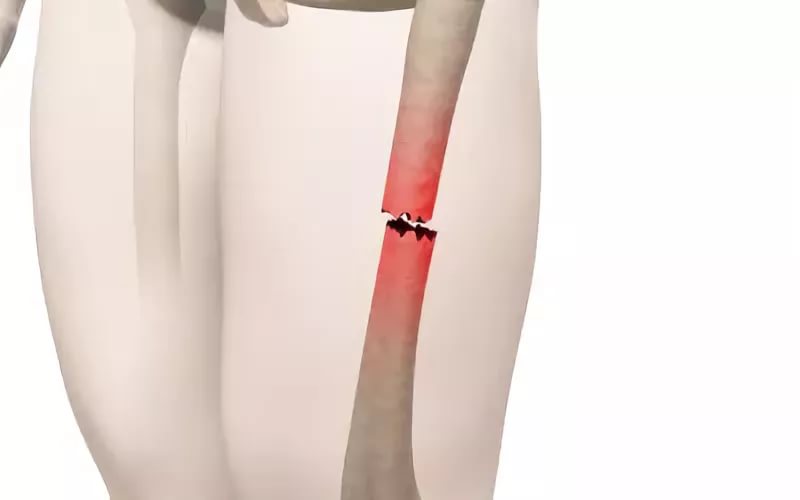 Растяжка ноги при переломе бедра thumbnail