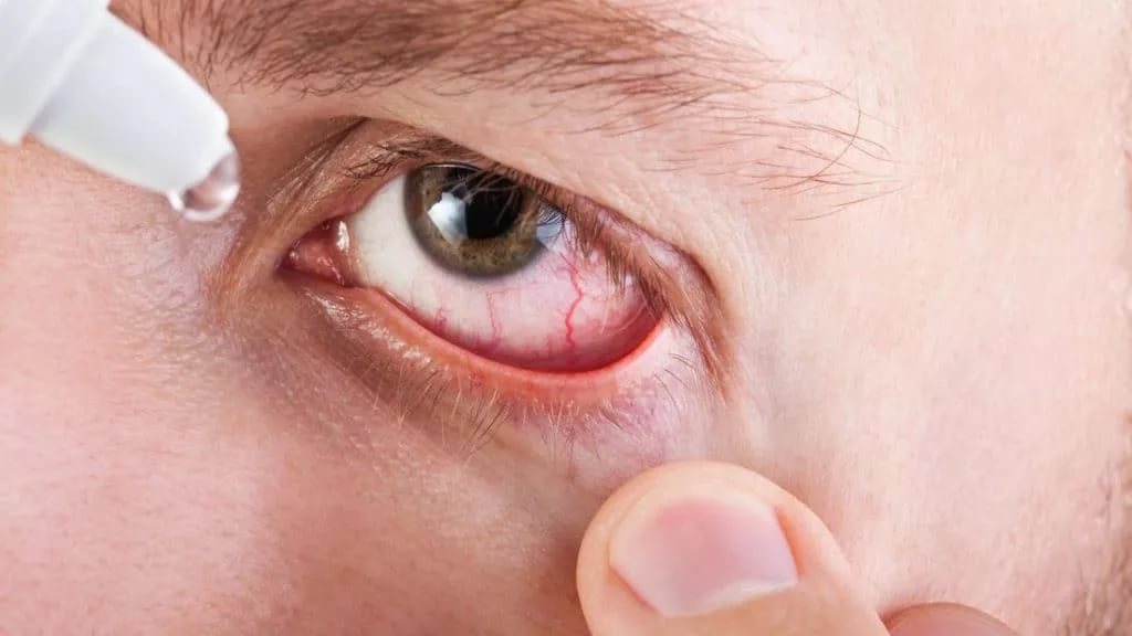 Простуда глаза лечение в домашних thumbnail