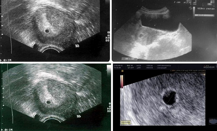 УЗИ 4 недели беременности
