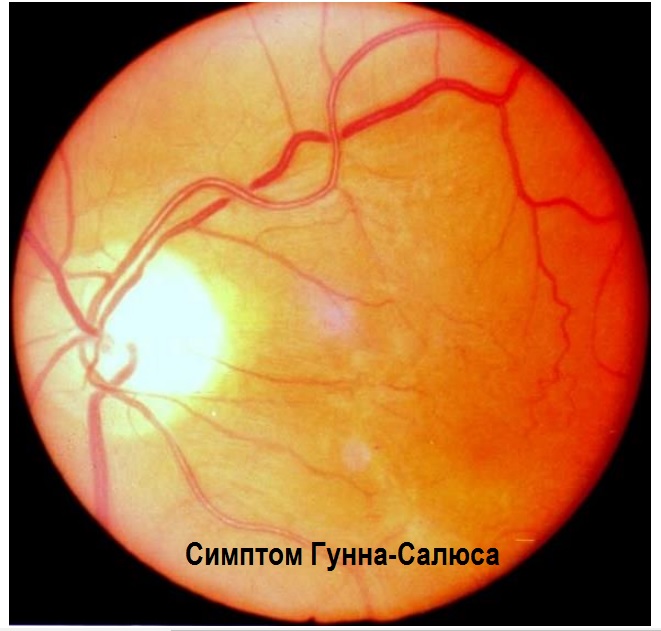 Глазное дно при гипертонической болезни - симптом Гунна-Салюса