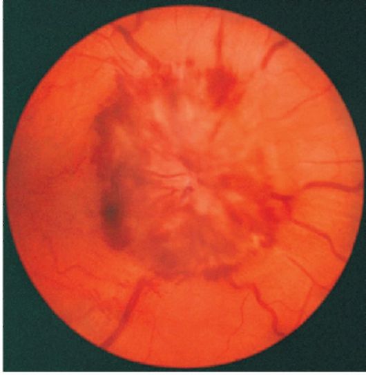 Глазное дно при гипертонической болезни - отек диска зрительного нерва