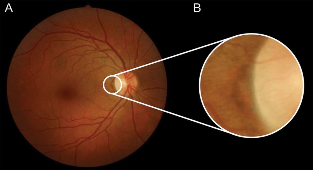 Глазное дно при гипертонической болезни - офтальмоскопия