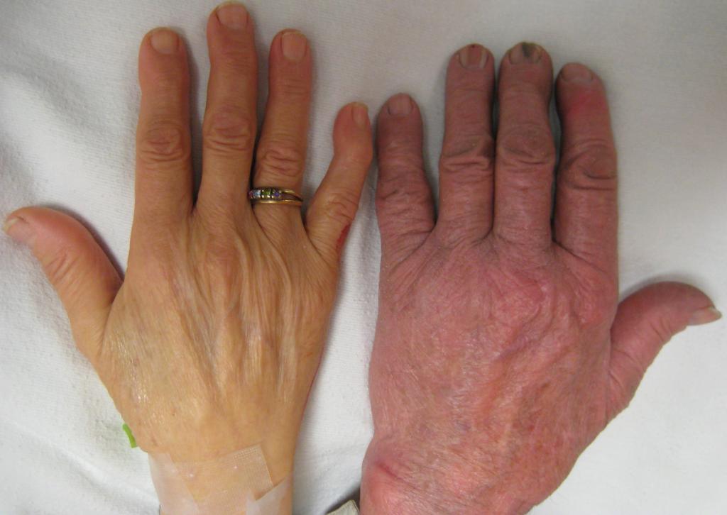 Рука здорового человека и больного анемией