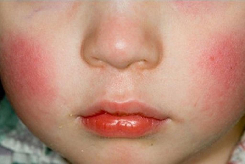 Аллергия на "Нурофен" у ребенка