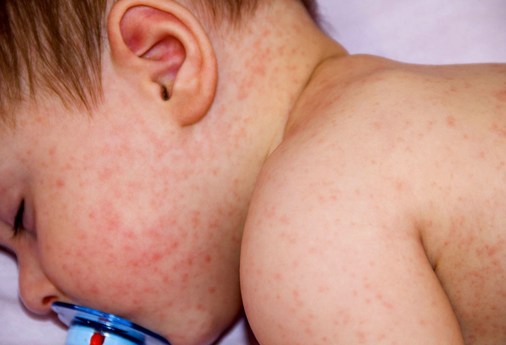 Аллергия у ребенка 1 года на картошку thumbnail