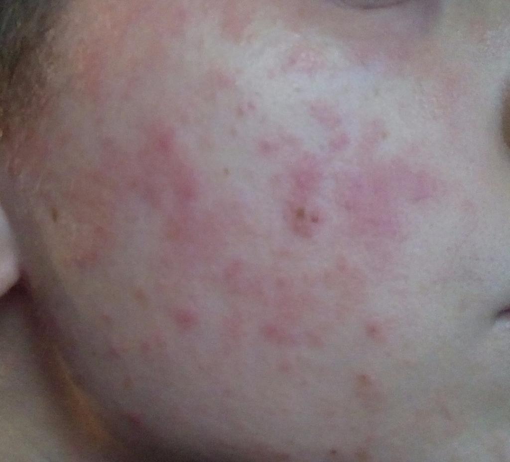 Началась аллергия на гепариновую мазь thumbnail