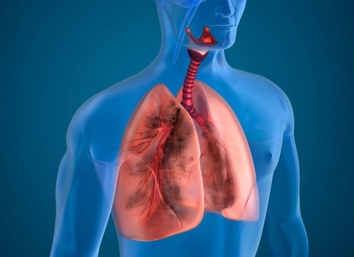 Туберкулез - опасное заболевание