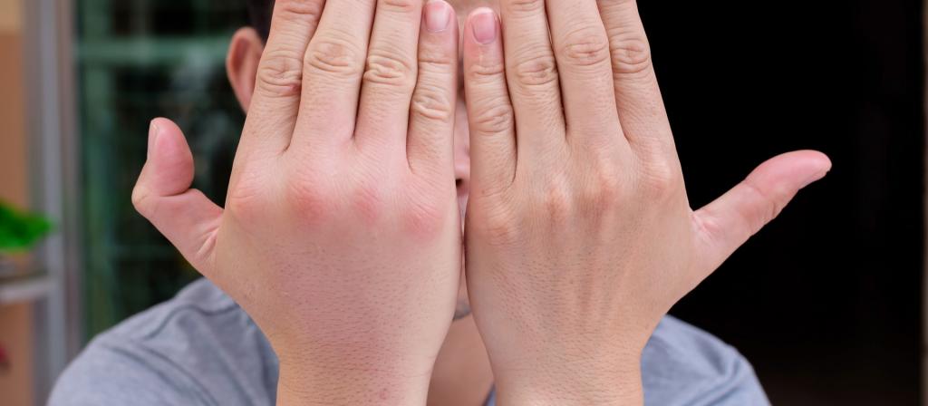Распухли пальцы на руках аллергия thumbnail