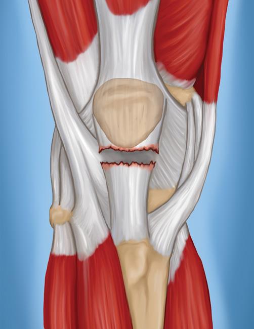 Мышцы ног в области колена thumbnail