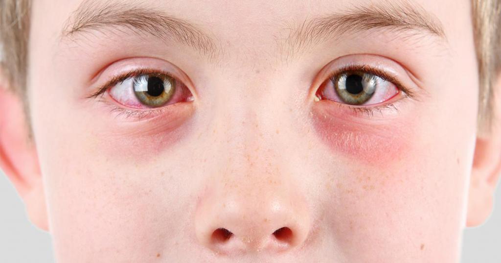 Лечение отеков под глазами у детей thumbnail