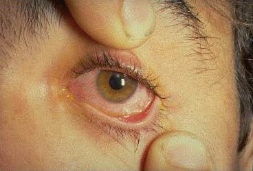 Ожог глаз кипятком лечение
