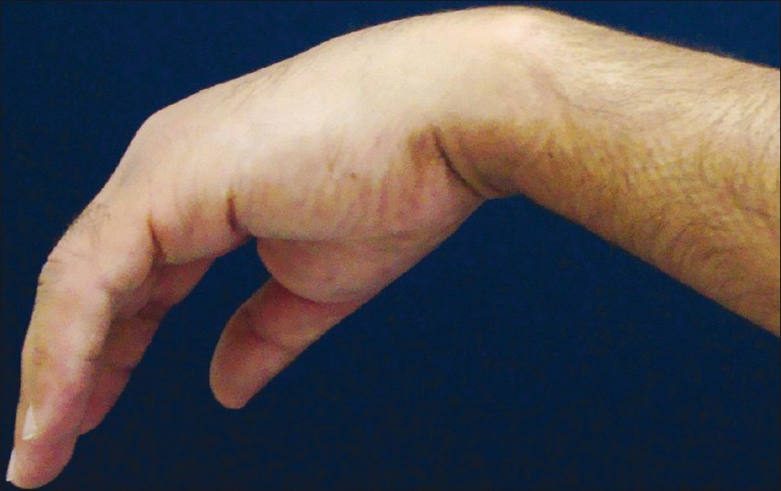 Защемление лучевого нерва руки лечение thumbnail
