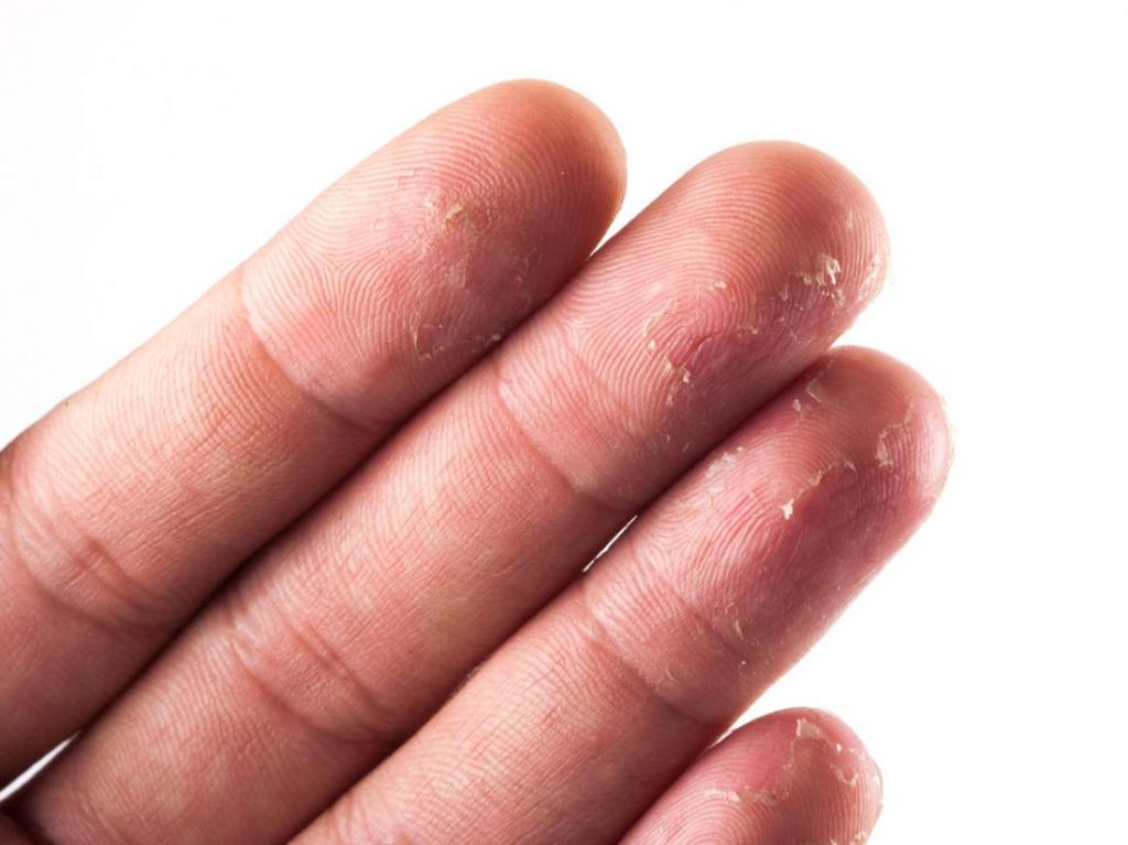 Аллергия на пальцах рук фото