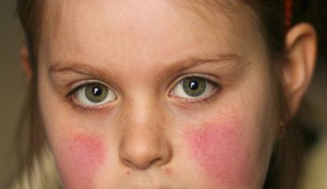 Туберкулез кожи у детей