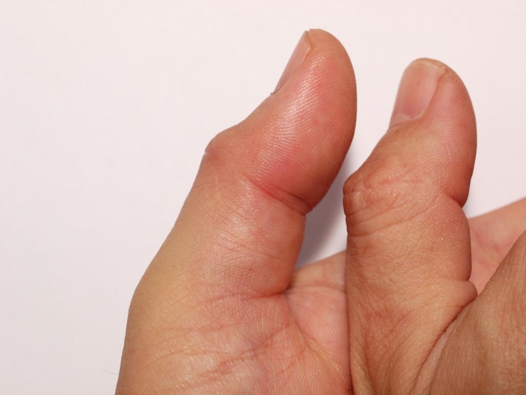 Помощь при переломе большого пальца руки thumbnail