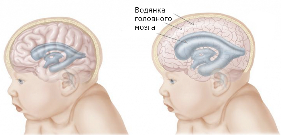 Водянка головного мозга у ребенка