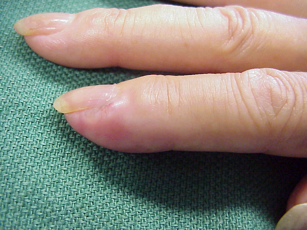 Рак кожи пальцев рук в руки thumbnail