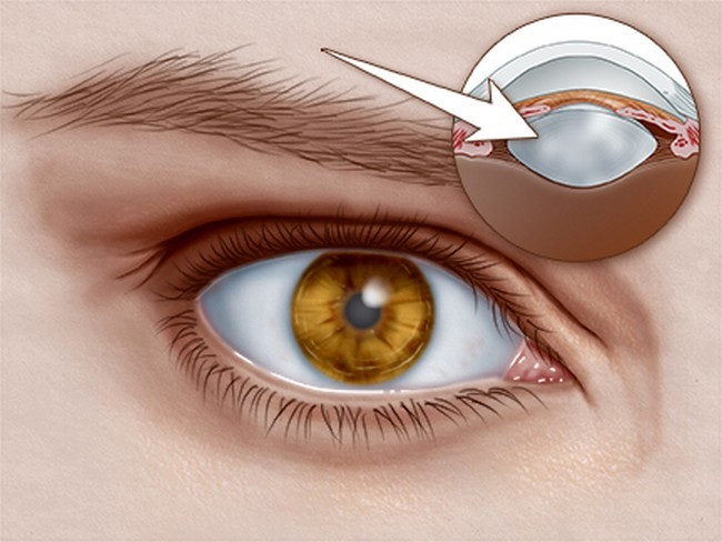 заболевание глаз у человека