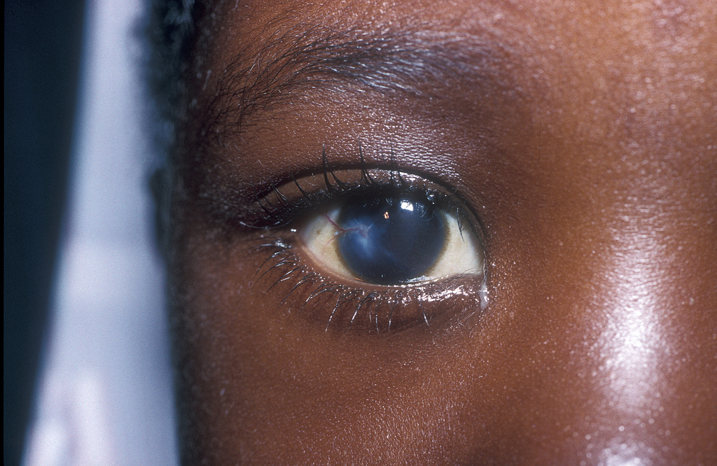 причины заболевания глаз
