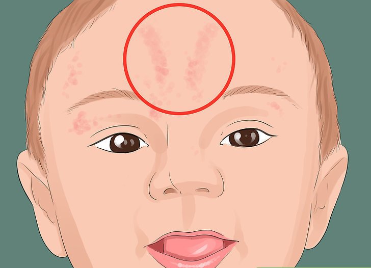 Гемангиома на голове у ребенка