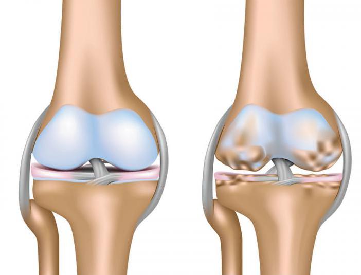 Уколы плазмы в коленный сустав отзывы