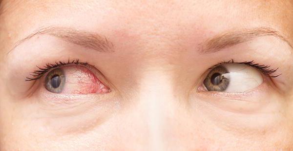 Травма глаза причины лечение