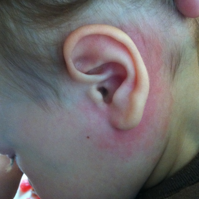 Воспаление кожи за ушами у ребенка thumbnail