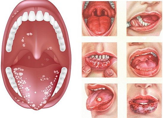 Как выглядит аллергия на слизистой рта thumbnail