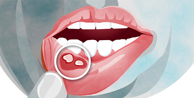 Аллергическая сыпь во рту у взрослых фото thumbnail