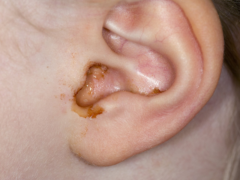 Когда пройдет заложенность уха при отите после лечения thumbnail
