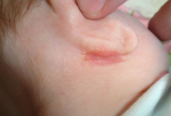 Аллергия за ухом у новорожденного thumbnail