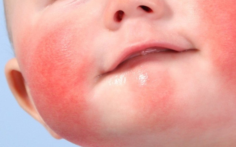 У ребенка может быть аллергия на перепелиные яйца thumbnail