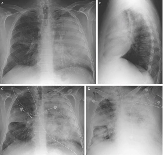 Рентген легких ребенка при бронхите фото thumbnail